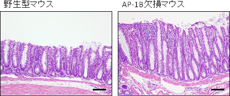 AP-1B欠損マウスはクローン病に類似した大腸炎を発症するの図