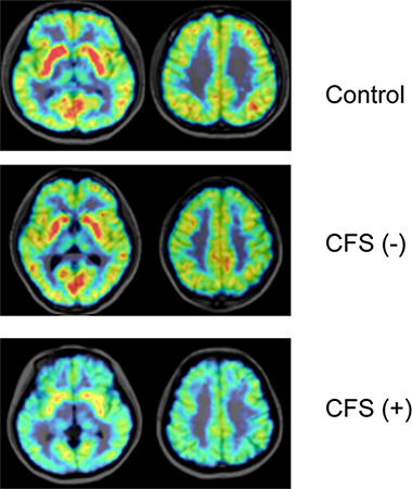 慢性疲労症候群患者の自己抗体が脳の神経伝達に与える影響の図
