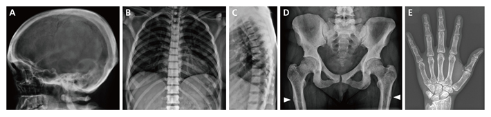 Ikegawa型大理石骨病患者のX線像の写真