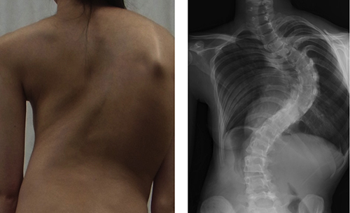 Photo and x-ray of girl with adolescent idiopathic scoliosis 