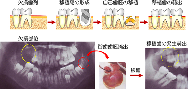 自家歯胚移植による歯の再生治療の図