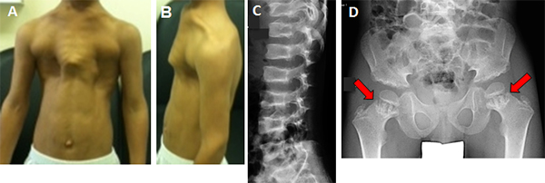 軸性脊椎骨幹端異形成症の病像