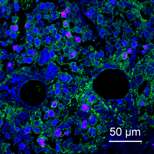 Photo of immunoflourescence staining of HCC cells expressing MYCN