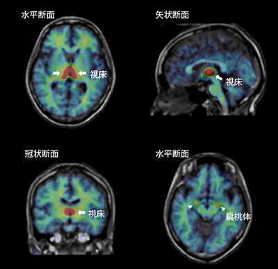 アロマターゼのヒト脳での分布の図