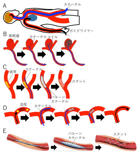 さまざまな血管内治療の模式図の画像