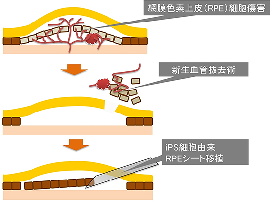 iPS細胞由来網膜色素上皮（RPE）シートの移植説明図
