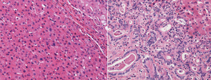 Image of liver tumor tissue