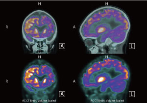 PET image of human brain