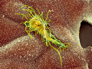 Image of a carcinoma cancer cell
