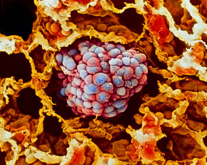 Image of lung cancer cells