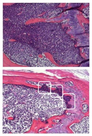 Image of bone sections from AML-engrafted mice
