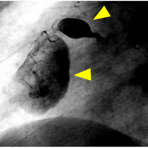 Image of giant coronary aneurysms caused by Kawasaki disease