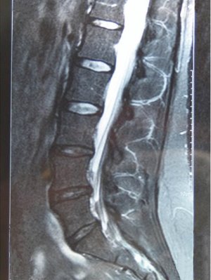 MRI of herniated discs