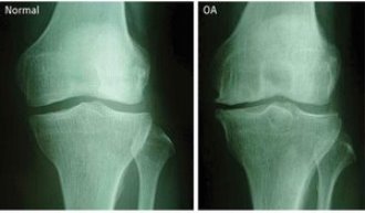 Radiographs of normal and OA knees