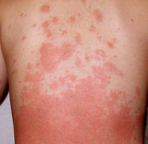Image of skin rash