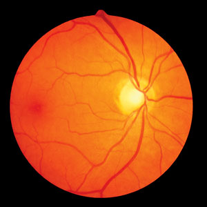Image of a healthy eye