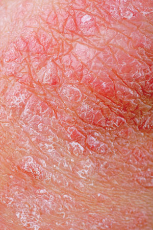 Image of skin with psoriasis