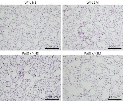 Image of cells with chronic obstructive pulmonary disease