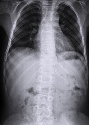 Image of the spine with brachyolmia