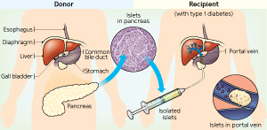 Schematic showing the process of clinical islet transplantation