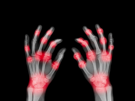 Image of Rheumatoid arthritis