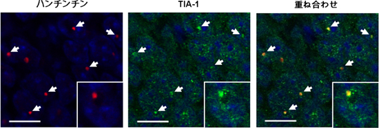 ハンチントン病モデルマウスの海馬におけるTIA-1とハンチンチン凝集体との共局在の図