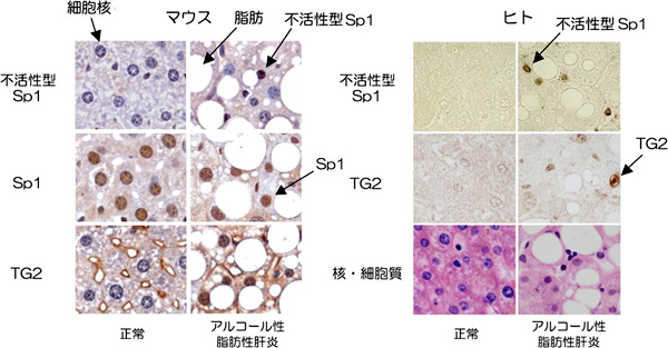 アルコール性脂肪性肝炎のモデルマウスと患者の肝組織の図