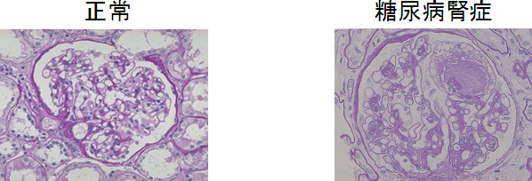 糖尿病腎症の腎臓の図