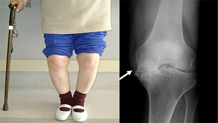 変形性膝関節症の写真