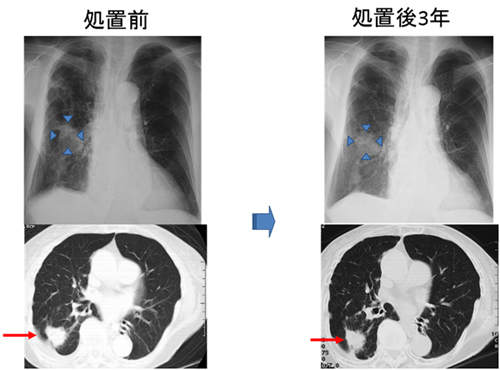 肺がん患者におけるNKT細胞療法結果の図