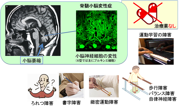 脊髄小脳変性症による運動失調の図