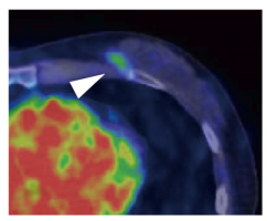 HER2陽性乳がん原発巣におけるトラスツズマブPETプローブの集積の図