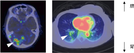 HER2陽性乳がん転移巣でのトラスツズマブPETプローブの集積の図