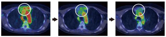 トラスツズマブPETプローブで経過観察したトラスツズマブ治療の効果の図