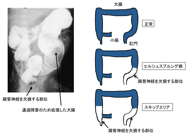 ヒルシュスプルング病とスキップエリアの図