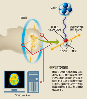 PET（陽電子放射断層画像撮影法）の図