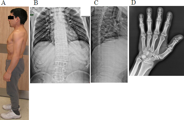 1型短体幹症の病態（29歳、男性患者）の図