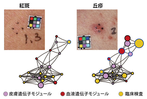 皮膚症状で異なる遺伝子発現パターンの図