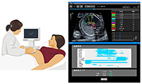 AIを用いた胎児心臓超音波スクリーニングの図