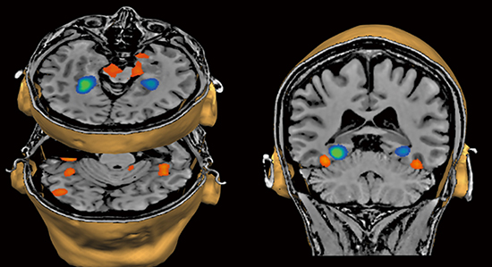 MRI装置で撮影された脳の図