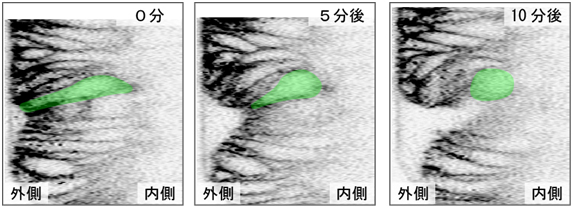 分裂期球形化による陥入の加速図