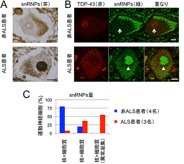 ALS患者の脊髄運動神経細胞におけるsnRNPsの核内異常蓄積の図