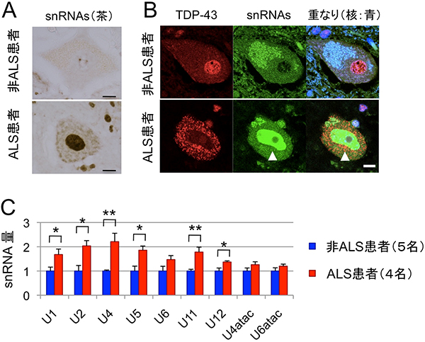 ALS患者の脊髄運動神経細胞におけるsnRNAsの異常蓄積の図