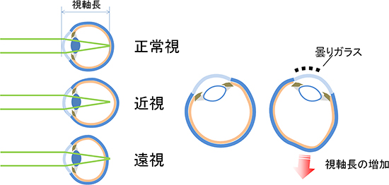 近視、遠視、正常視の関係（左）と　片目の一部分の光情報を遮断した眼球（右）の図