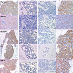 Photos showing eradication of AML cells by RI-20049