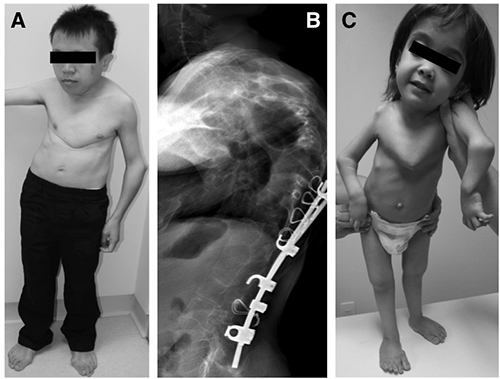 Pictures and X-ray of patients with B3GALT6 mutations