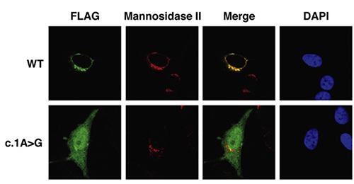 Photos showing localization of B3GALT6 in HeLa cells transfected with wild type and mutant B3GALT6