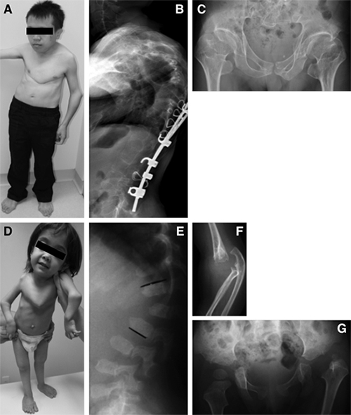 関節弛緩を伴う脊椎骨端骨幹端異形成症I型（SEMD-JL1）とEhlers-Danlos症候群早老性型（EDS-PF）の臨床像の画像