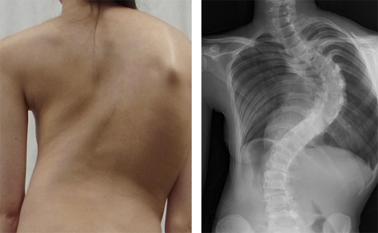思春期特発性側彎症 Ais 発症に関連する遺伝子 Gpr126 を発見 理化学研究所