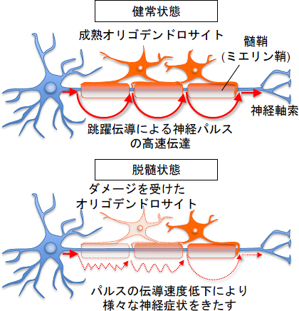 正常時と脱髄時の神経信号の伝達の図
